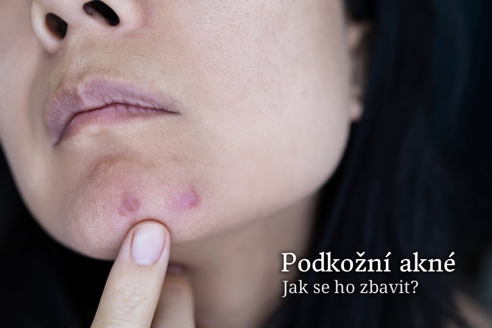 Podkožní akné